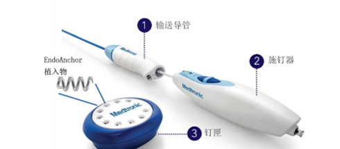 血管内锚定系统